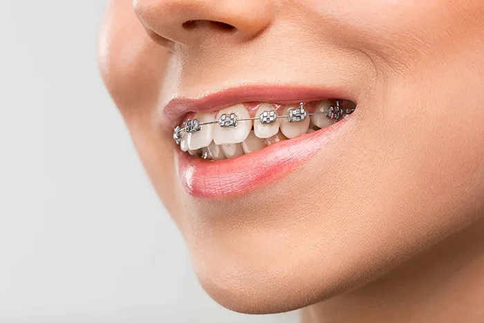 Invisalign